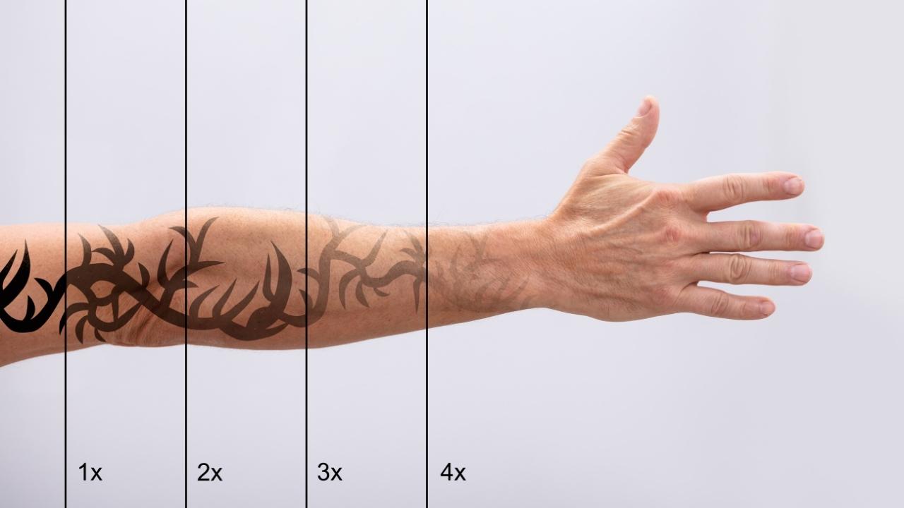Extinct Ink Laser Tattoo Removal