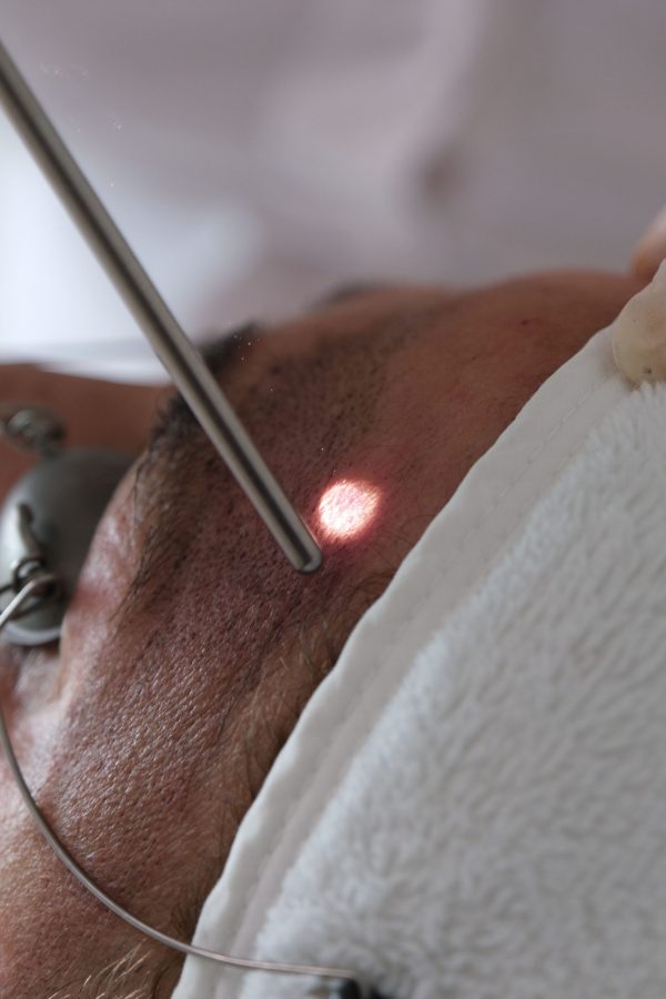 Lazerle Karbon Peeling