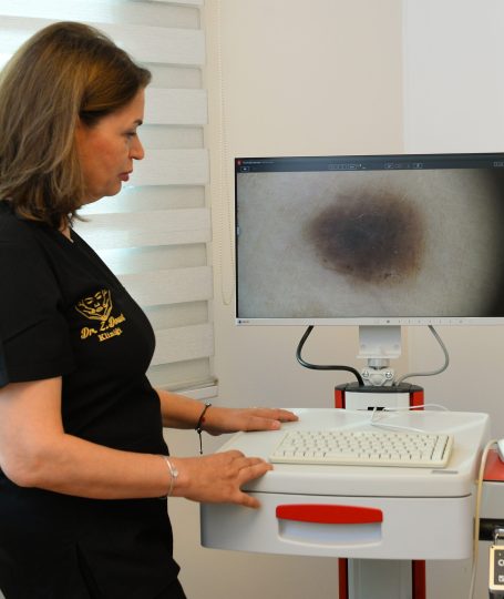 dermatoskop ile ben muayenesi